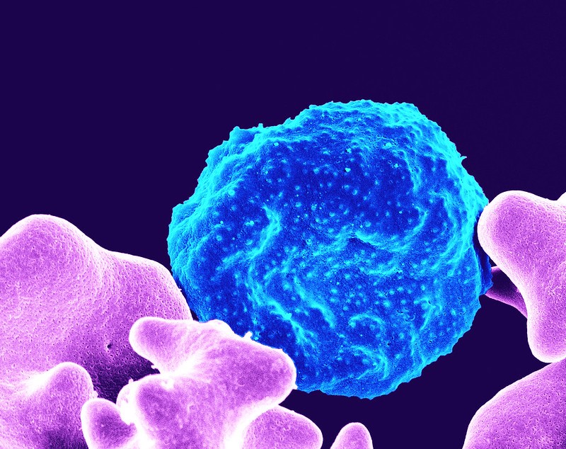 This colorized scanning electron micrograph shows a red blood cell infected with malaria parasites (blue). The small bumps on the infected cell show how the parasite can avoid destruction and cause inflammation. Uninfected cells (pink) have smoother surfaces.