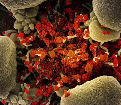 Colorized scanning electron micrograph of an apoptotic cell (tan) heavily infected with SARS-COV-2 virus particles (orange).