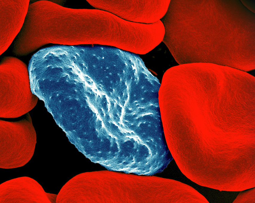 A colorized scanning electron micrograph of red blood cell infected with malaria parasites (blue). It has a bumpy surface. The surrounding uninfected red blood cells have smooth surfaces.