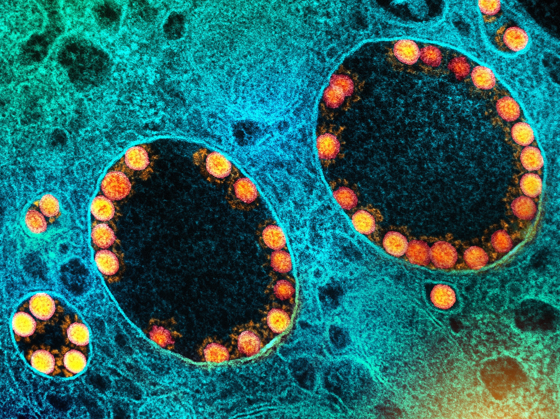 A Transmission electron micrograph of spherical SARS-CoV-2 virus particles, within endosomes of a heavily infected nasal olfactory epithelial cell.