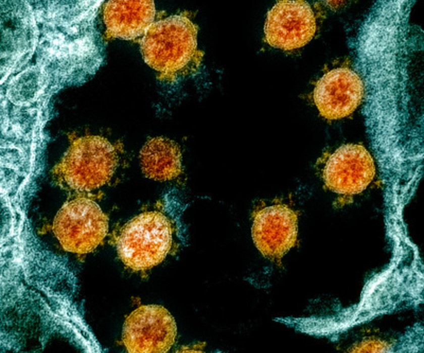 SARS-CoV-2 particles isolated from a patient and shown on a colorized scanning electron micrograph