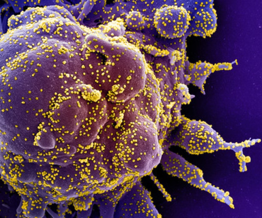 A colorized scanning electron micrograph of an apoptotic cell, shown in purple, that is heavily infected with SARS-CoV-2 particles, shown in yellow, and has been isolated from a patient sample