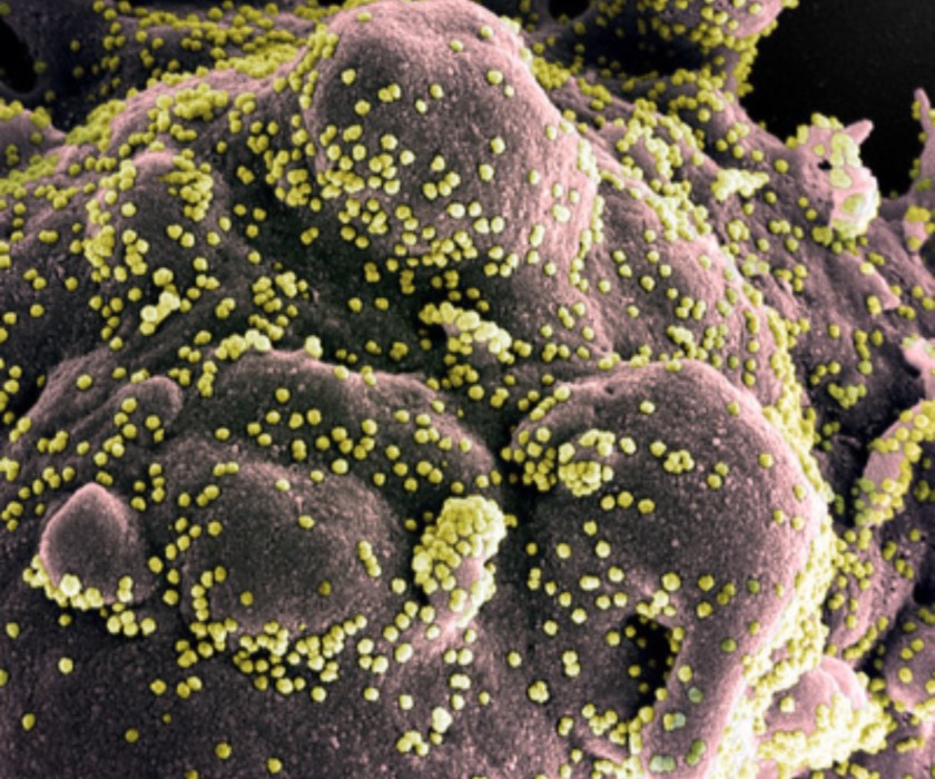 A colorized scanning electron micrograph that shows SARS-CoV-2 particles isolated from a patient