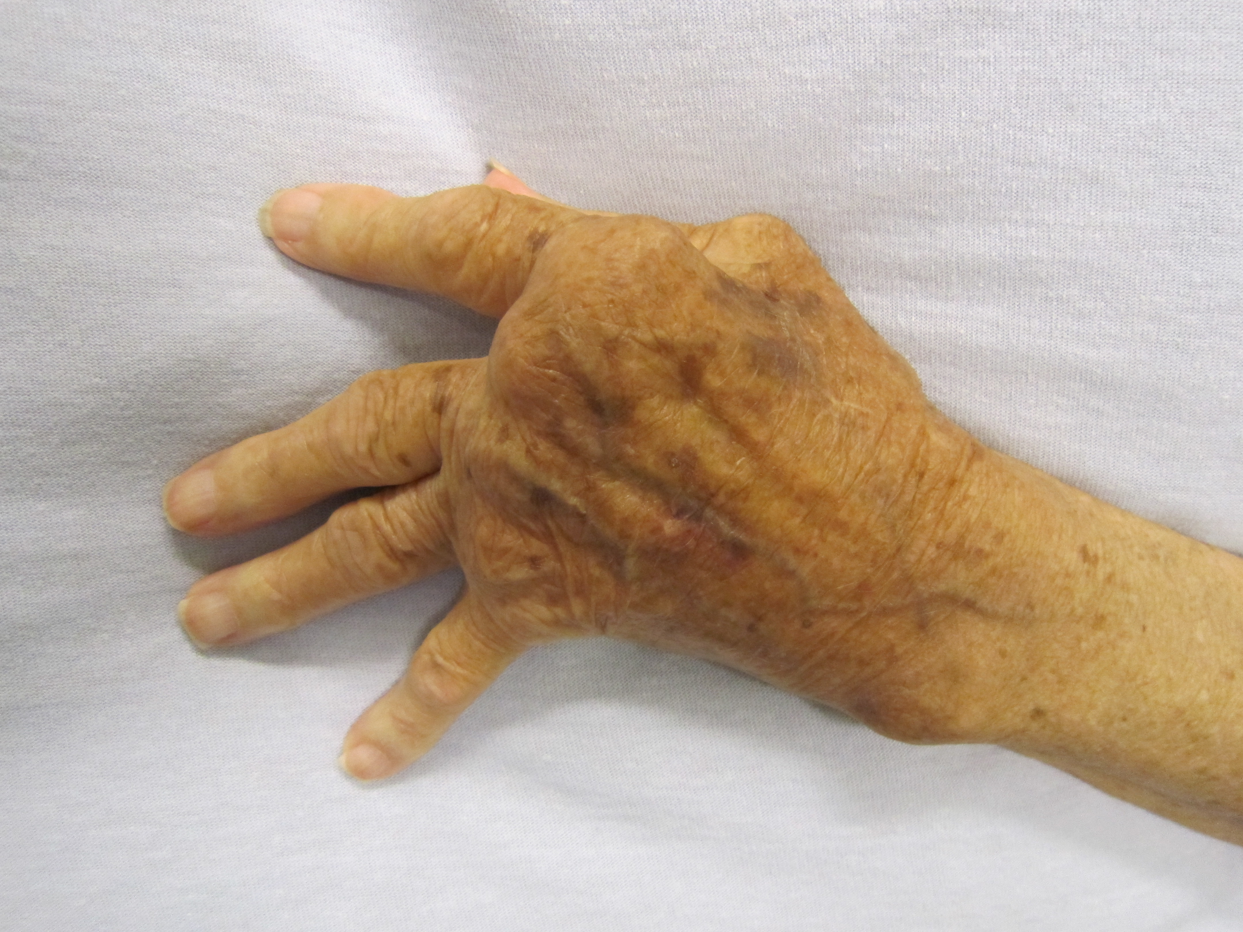 Photo of hand affected by rheumatoid arthritis