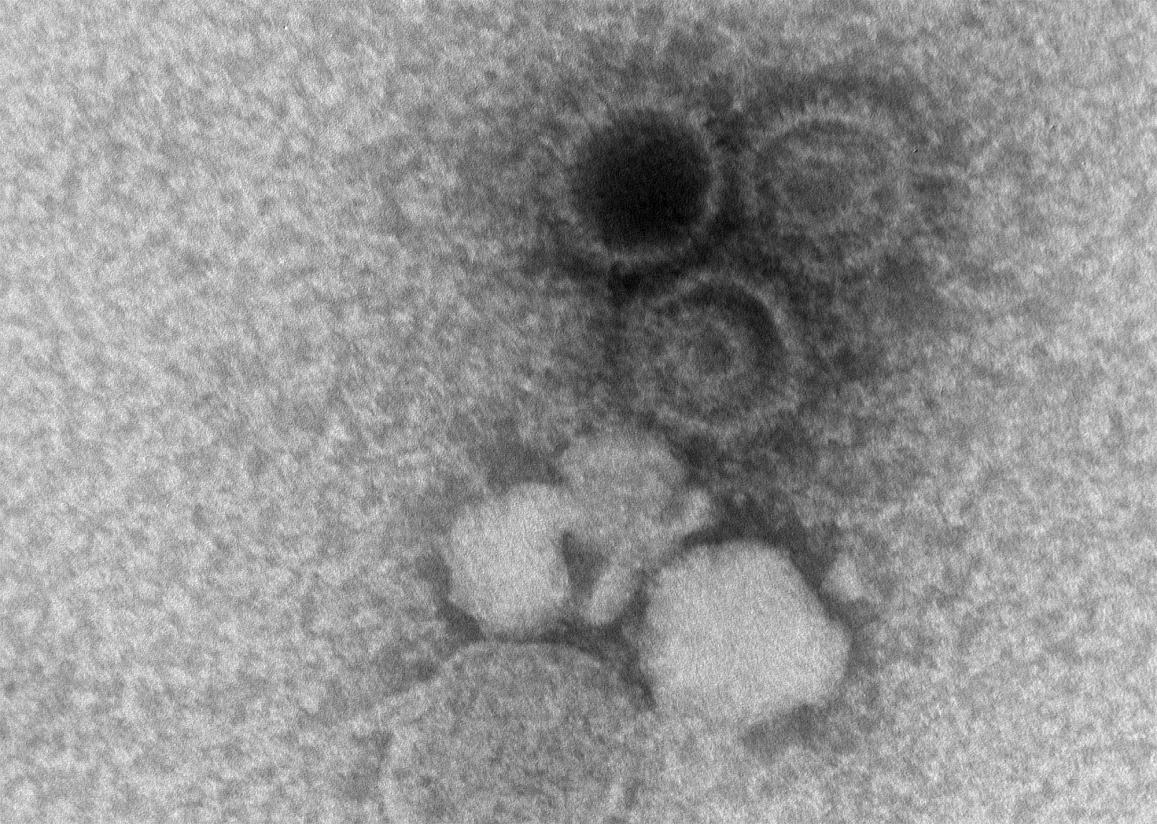 An electron microscopy image showing three Epstein-Barr virions. 