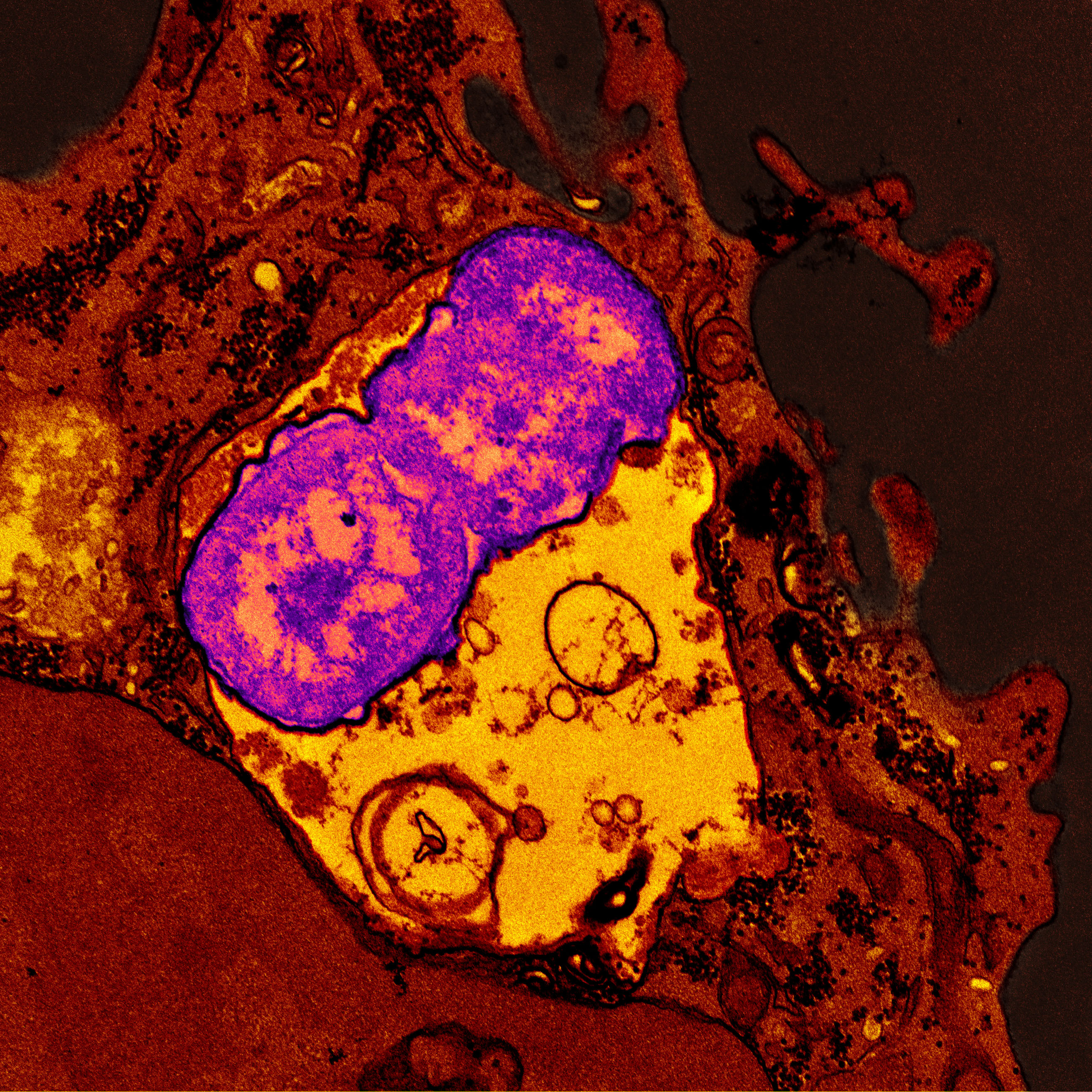 A human neutrophil is shown in red after ingesting Klebsiella pneumoniae bacteria, shown in purple.