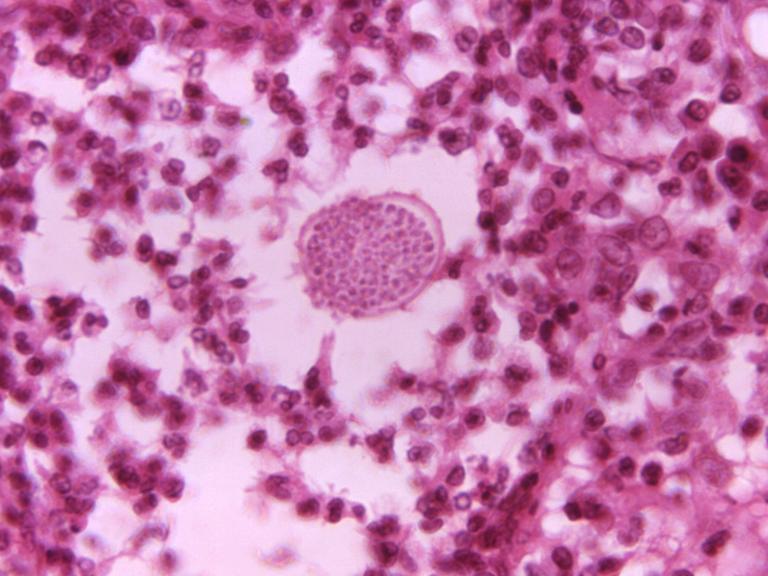 A photomicrograph of a tissue sample from a patient with Valley Fever. A fungal spherule, which would later rupture to release endospores into the surrounding tissue, appears as a speckled circle in the center.