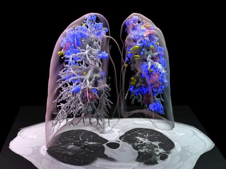 digitized image of lungs