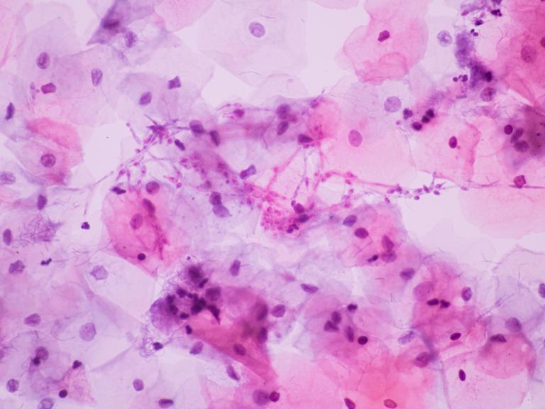 microscopic of Candidiasis, fungus infection (Yeast and Pseudohyphae form) in pap smear slide 