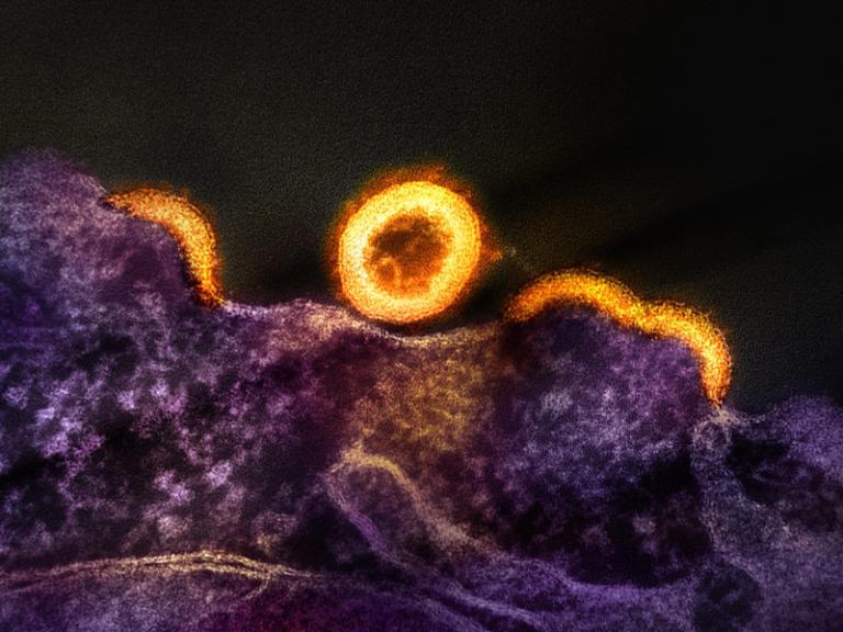 Yellow/gold HIV-1 virus particles replicating from a purple HIV-infected H9 T-cell. Semi-circle shaped virus particles that have not yet separated from the cell appear and a separated, with a spherical immature particle at center of the image.