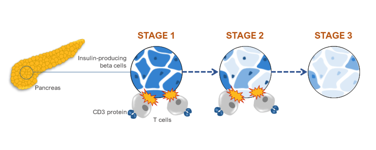 Illustration of a pancreas on the left with a circle showing zooming in on the cells. Three circles, one for each stage, on the right. Stage 1 shows the beta cells with CD3 protein and T cells. Stage 2 shows this same but with fewer beta cells. Stage 3 shows fewer beta cells and no CD3 protein or T cells.