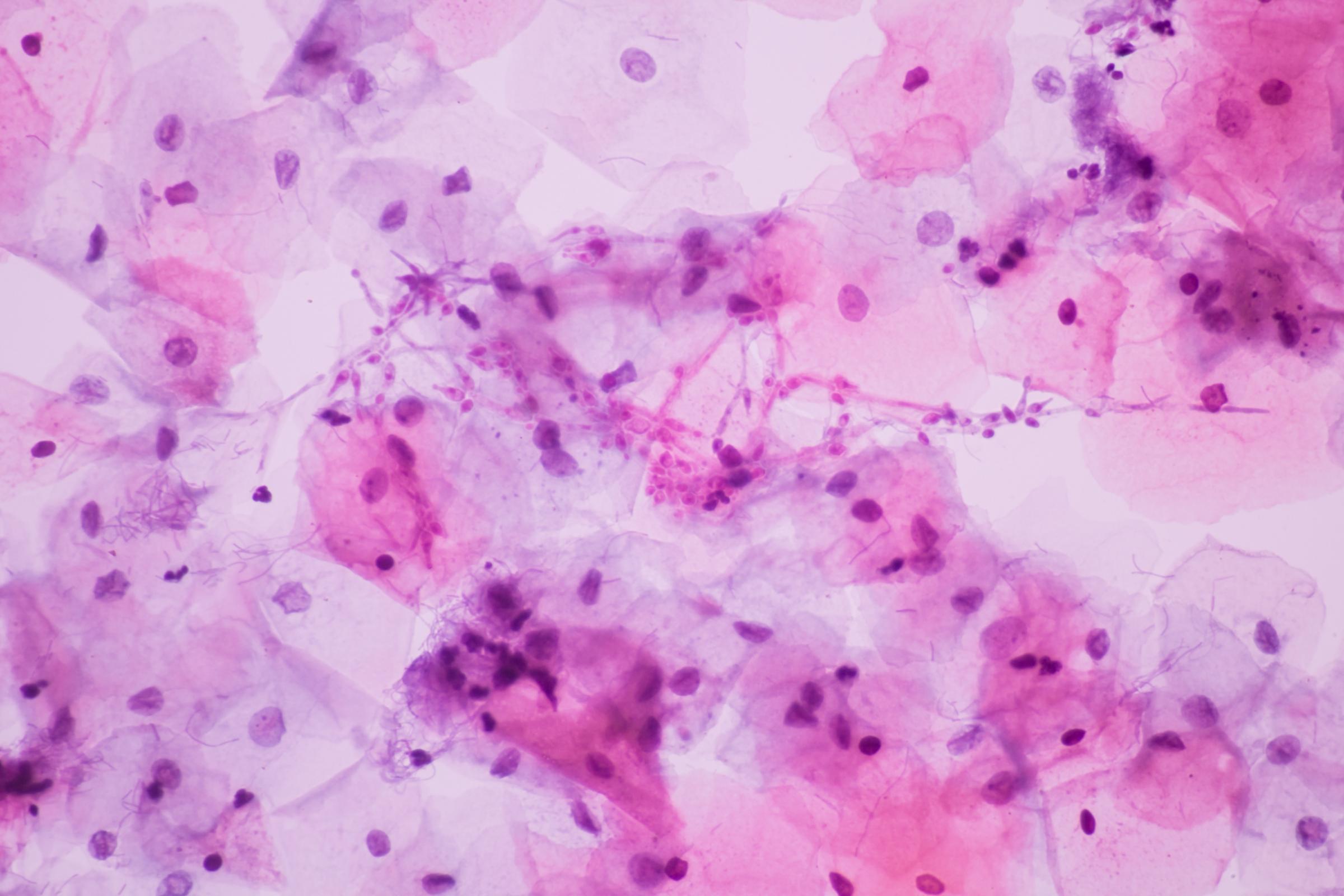 microscopic of Candidiasis, fungus infection (Yeast and Pseudohyphae form) in pap smear slide 