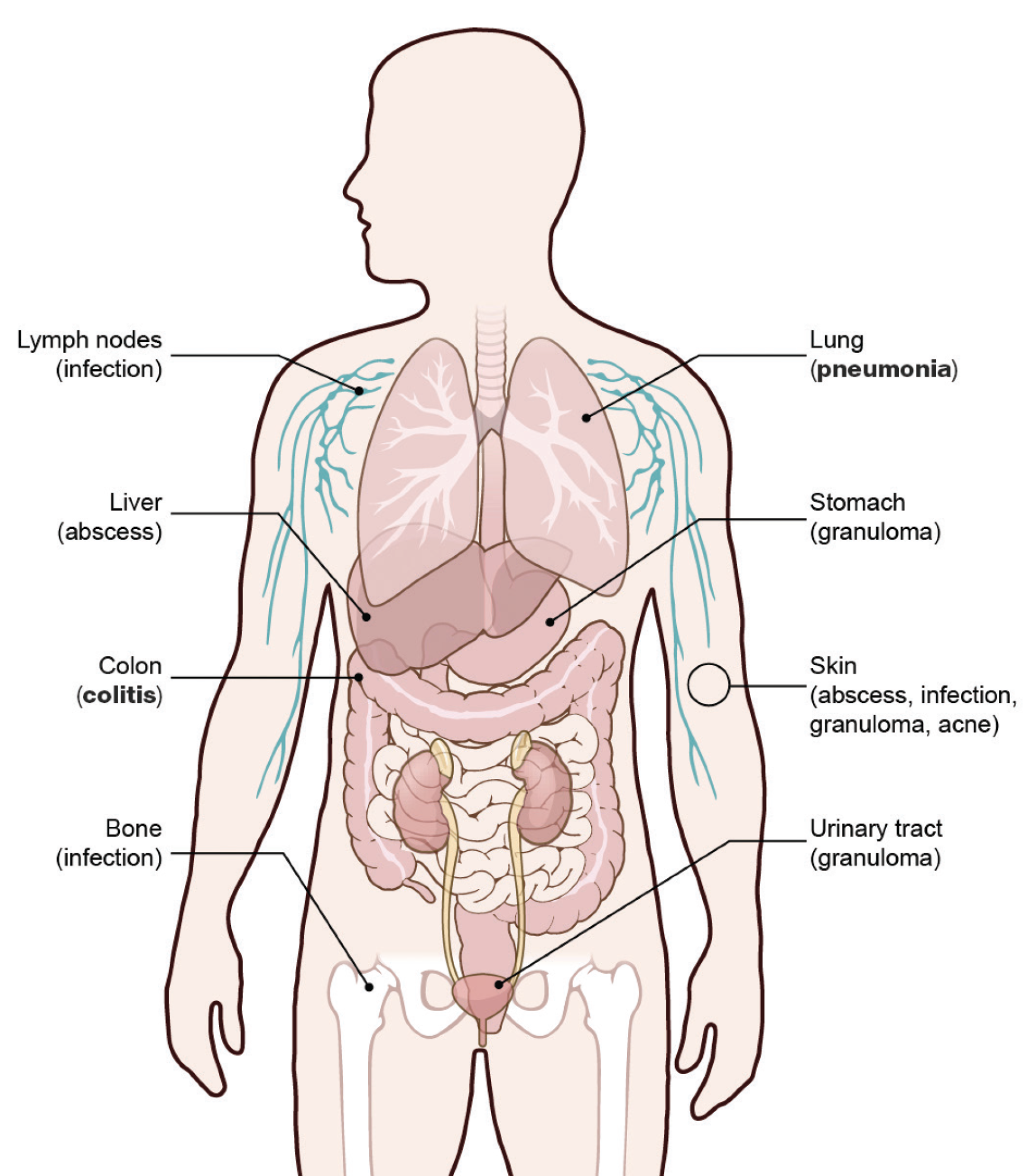 image of a human figure with organs overlayed. Labeled are lymph nodes (infection), liver (abscess), colon (colitis), bone (infection), lung (pneumonia), stomach (granuloma), skin (abscess, infection, granuloma, acne), and urinary tract (granuloma)