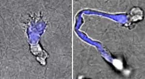 Image of T cells from a healthy donor compared to a DOCK8-deficient patient.