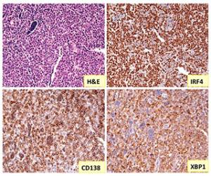 Immunohistochemical analyses of a plasmacytic plasmacytoma, which show IRF 4 expressed in the cell nucleus, CD138 on cell membrane, and XBP1 in cytosols