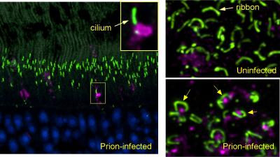 (left panel) Early in prion infection, a prion protein aggregate (magenta) blocks the entrance to a cilium (green) in a retinal photoreceptor. (lower right) In prion-infected retina, prion protein (magenta) accumulates under the horseshoe-shaped ribbon synapses (green) found in photoreceptor terminals. 