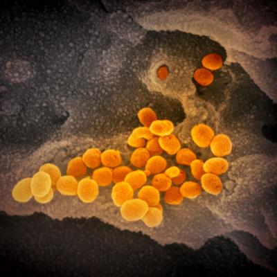 scanning electron microscope image shows SARS-CoV-2 (orange), the virus that causes COVID-19