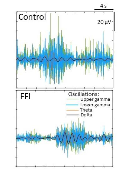 This image shows differences in brain waves, illustrating brain cell dysfunction in organoid models of fatal familial insomnia compared to controls.