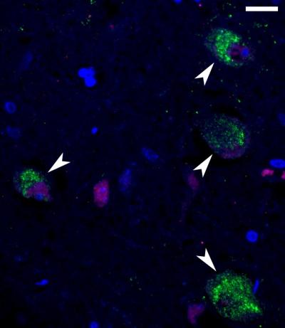 SARS-CoV-2 in the brain