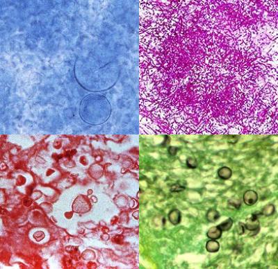 Collage of histological images of fungal diseases