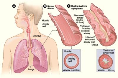 Illustration of key physiological differences between a normal lung airway and a lung airway in a person experiencing asthma symptoms. 