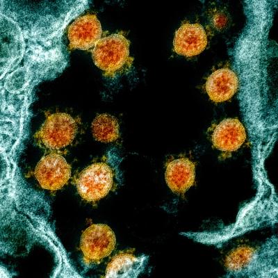 colorized transmission electron micrograph shows SARS-CoV-2 virus particles (orange)