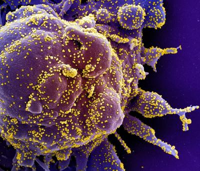 Colorized scanning electron micrograph of a cell (purple) heavily infected with SARS-COV-2 virus particles (yellow)