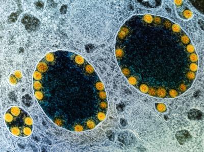 Transmission electron micrograph of SARS-CoV-2 virus particles (yellow) within endosomes of a heavily infected nasal Olfactory Epithelial Cell.