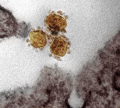 Transmission electron micrograph of SARS-CoV2