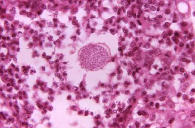 A photomicrograph of a tissue sample from a patient with Valley Fever. A fungal spherule, which would later rupture to release endospores into the surrounding tissue, appears as a speckled circle in the center.