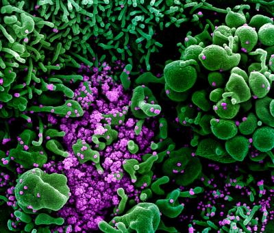 SEM of an apoptotic cell (green) heavily infected with SARS-COV-2 virus particles (purple)