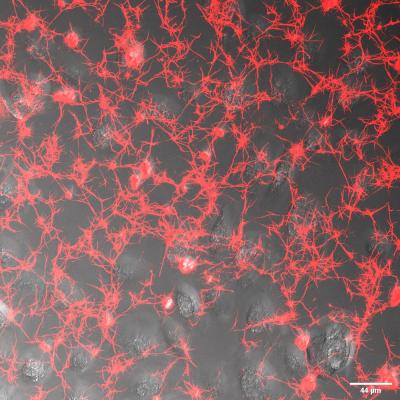 Image of fibrin deposits (red) associated with human lung epithelial cells infected with SARS-CoV-2.