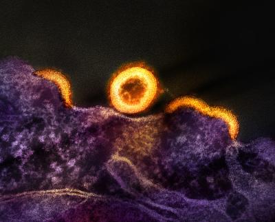 Yellow/gold HIV-1 virus particles replicating from a purple HIV-infected H9 T-cell. Semi-circle shaped virus particles that have not yet separated from the cell appear and a separated, with a spherical immature particle at center of the image.