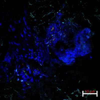 A lesional skin biopsy showing co-expression of the endothelial marker CD31 and the activation and adhesion marker, ICAM1 on Patient 1.