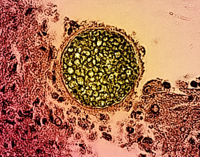 A round Coccidioides fungal spherule (colorized yellow) found in a tissue sample (colorized pink). It is round and contains many smaller round dots.