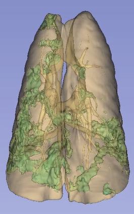 A 3D image of lungs showing green areas of infiltrate.