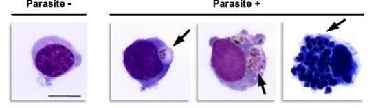 Human monocytes phagocytosing red cells infected with malaria parasites