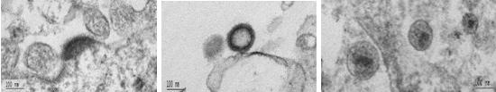 Electron micrographs showing the different steps of HIV-1 morphogenesis and budding