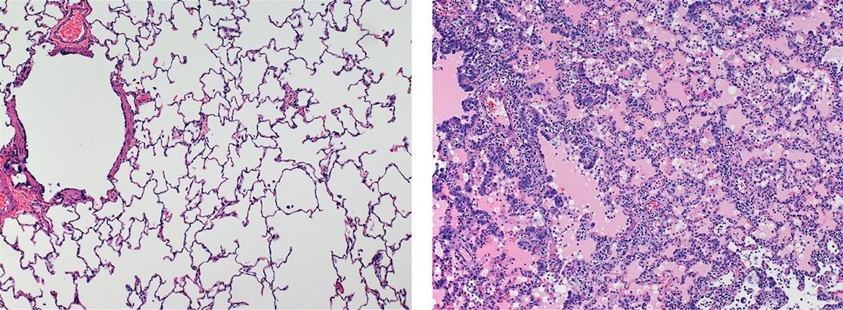 Lung Comparison Image