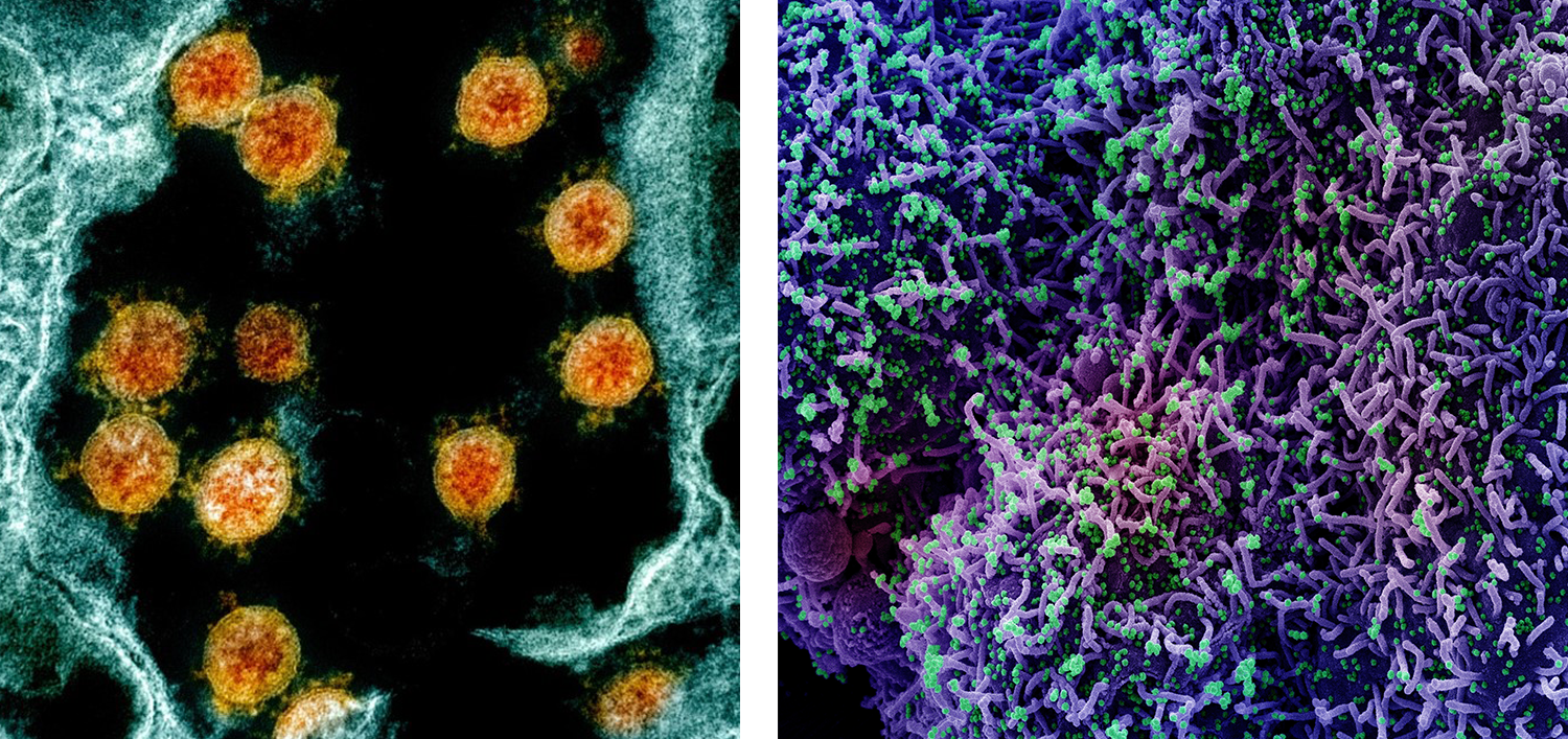 Left: Colorized transmission electron micrograph (TEM) of SARS-CoV-2 virus particles (orange) within an endosome of a Vero E6 cell (blue). Right: Colorized scanning electron micrograph (SEM) of CCL-81 cells (purple) infected with SARS-CoV-2 virus particles (green).