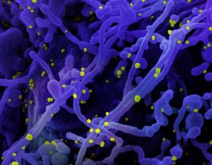 Colorized scanning electron micrograph of a cell (purple) infected with SARS-COV-2 virus particles (yellow), isolated from a patient sample. 