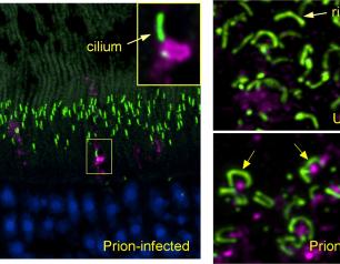 (left panel) Early in prion infection, a prion protein aggregate (magenta) blocks the entrance to a cilium (green) in a retinal photoreceptor. (lower right) In prion-infected retina, prion protein (magenta) accumulates under the horseshoe-shaped ribbon synapses (green) found in photoreceptor terminals. 