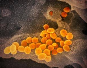 scanning electron microscope image shows SARS-CoV-2 (orange), the virus that causes COVID-19