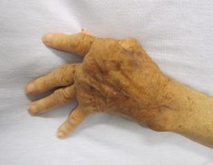 Photo of hand affected by rheumatoid arthritis