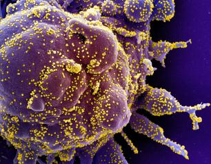 Colorized scanning electron micrograph of a cell (purple) heavily infected with SARS-COV-2 virus particles (yellow)