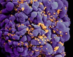 Scanning electron micrograph of an HIV-infected H9 T cell.