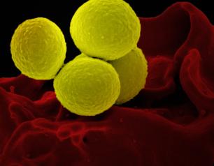 Scanning electron micrograph of a human neutrophil ingesting MRSA (yellow). 