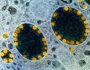 Transmission electron micrograph of SARS-CoV-2 virus particles (yellow) within endosomes of a heavily infected nasal Olfactory Epithelial Cell.