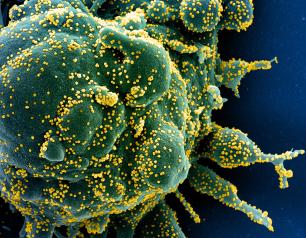 Colorized scanning electron micrograph of an apoptotic cell colored green, heavily infected with SARS-COV-2 virus particles, colored yellow