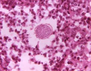 A photomicrograph of a tissue sample from a patient with Valley Fever. A fungal spherule, which would later rupture to release endospores into the surrounding tissue, appears as a speckled circle in the center.